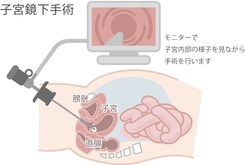 婦人科低侵襲手術／幸せな妊娠生活を送り、そして素敵な出産になるよう