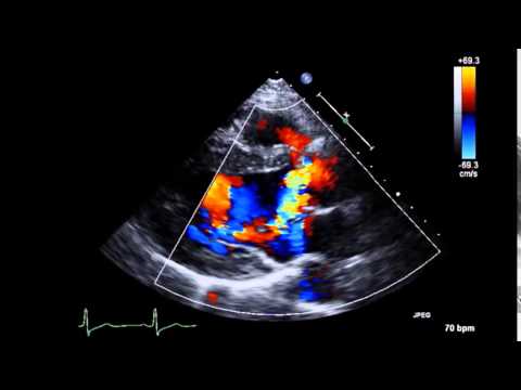 治療方針を決める大動脈弁逆流の心エコー | 「心臓」特別号「弁膜症