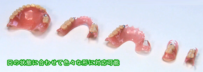 入れ歯・義歯は神戸市北区の歯科医院（歯医者）ミント歯科へ ノン