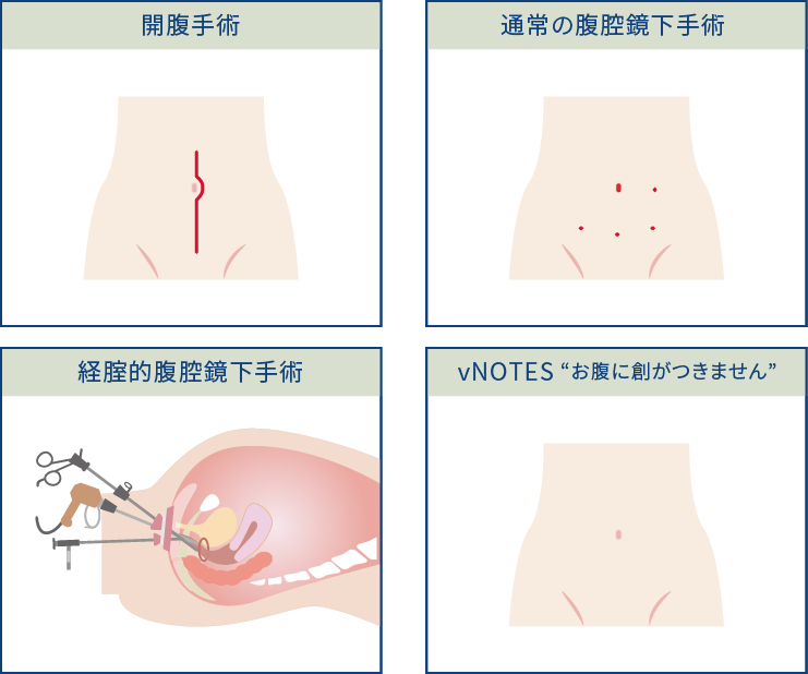 内視鏡・ロボット手術部門（腹腔鏡手術・子宮鏡手術） | 女性医療