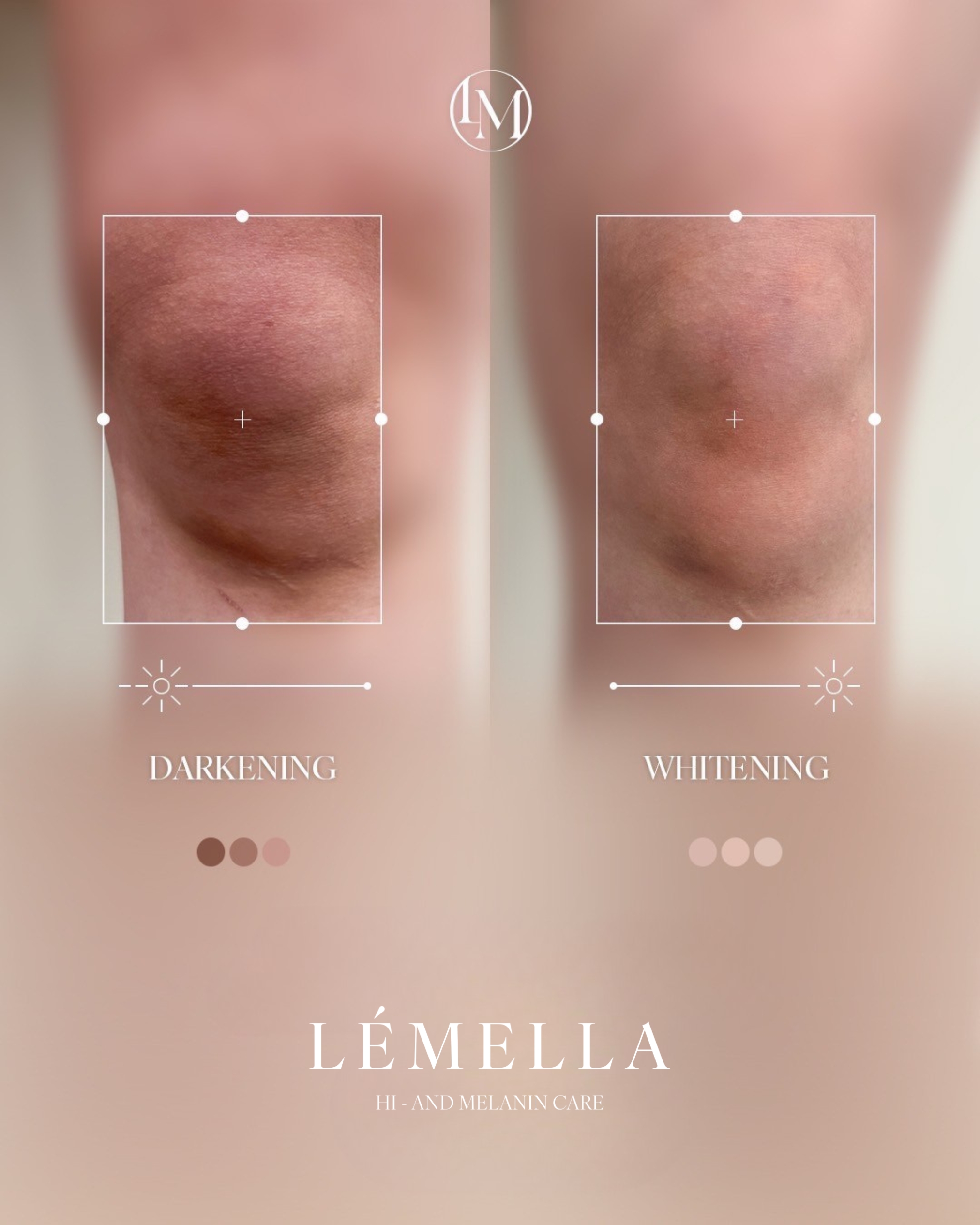 ルメラ（LEMELLA）メラニンケア｜豊橋の美容皮膚科 遠山クリニック