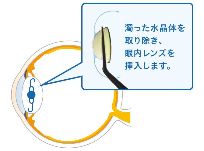 眼内レンズとは｜白内障の診療｜中部眼科