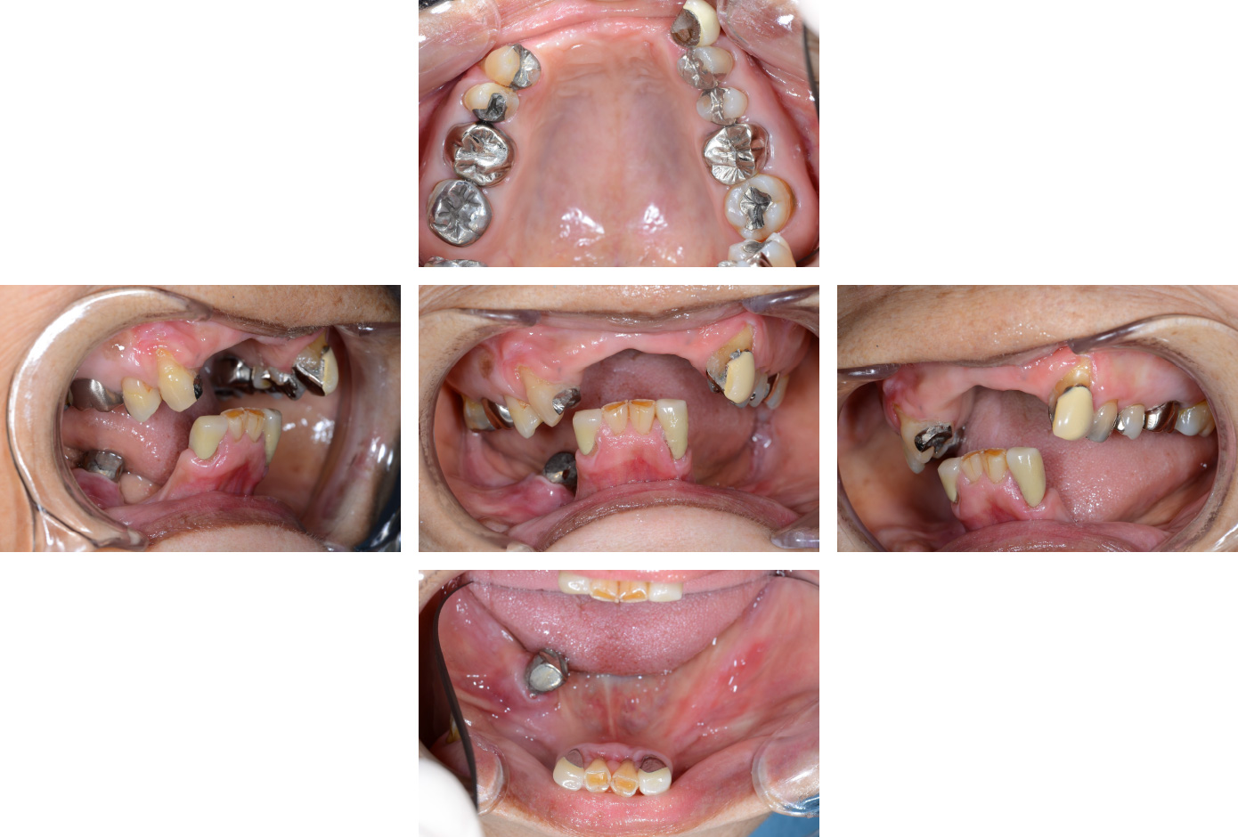 CASE10 義歯（入れ歯）症例 | 秋津の歯医者・徹底した痛みへの配慮