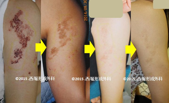 毛細血管奇形（単純性血管腫） | あざ治療の専門クリニック｜西堀形成外科