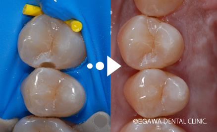 MI治療 なるべく削らない 低侵襲の歯科 | 福岡市城南区