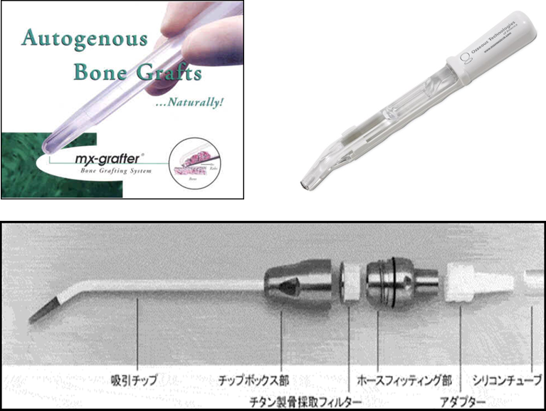 インプラント治療の骨造成術のGBR・GTR｜歯科口腔外科塾GBR・GTR