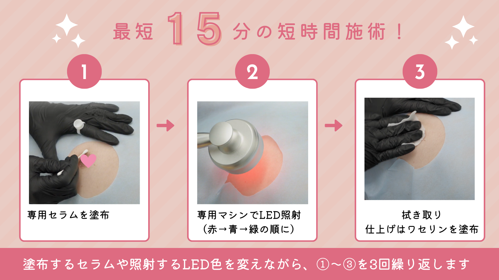 エステティック通信読者に速報！ 黒ずみケアの次世代施術「ローマ