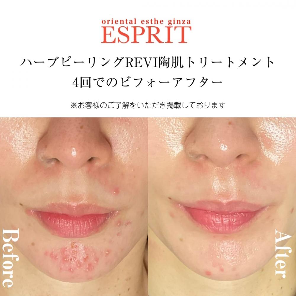 REVI陶肌トリートメントで“自分史上最高の素肌”へ！エスプリのビフォー