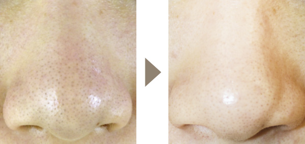 毛穴リメイク | フェイシャル【エステサロンKAREN（カレン）】