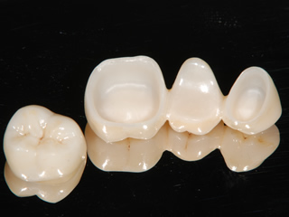 フルジルコニア・オールジルコニア・オールセラミッククラウン｜歯科