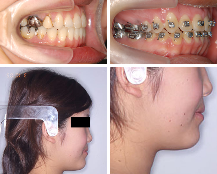 顎変形症｜きょうばし矯正歯科クリニック