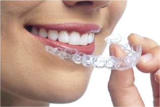 マウスピース型矯正装置（インビザライン）｜岡山じんの矯正歯科