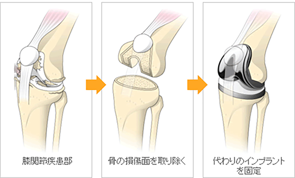 人工膝関節置換術（TKA） – 三田市民病院