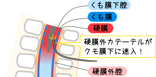 硬膜外鎮痛法(エピ)の観察と看護 | 見て！わかる！病態生理と看護