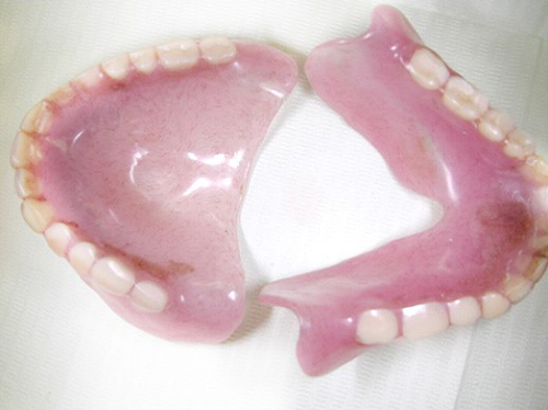 入れ歯（義歯）】 | 医療法人 鵬瑛会 豊岡ヘルシークリニック