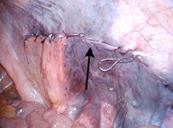腹腔鏡下鼠径ヘルニア修復術（TAPP法）について | ヘルニアの種類と