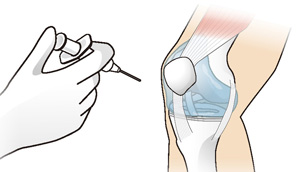 中瀬 順介 先生 | 半月板損傷の保存療法と手術療法 | 半月板の治療は