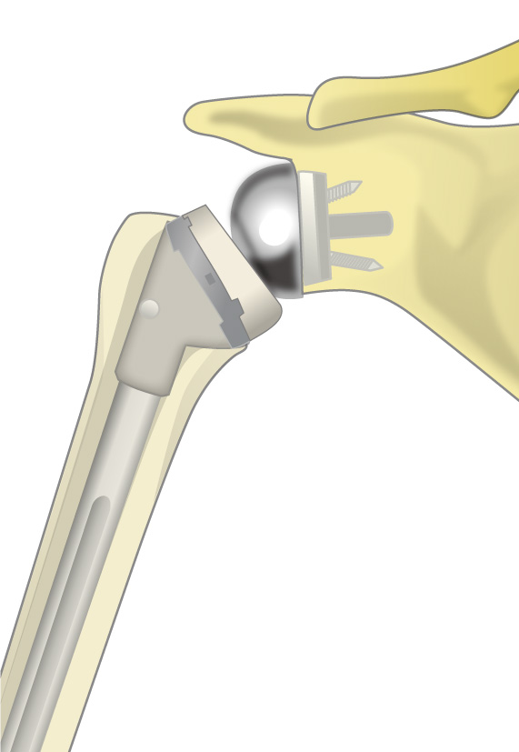 谷口 昇 先生 | 「人工肩関節置換術」とその詳細について | リバース型