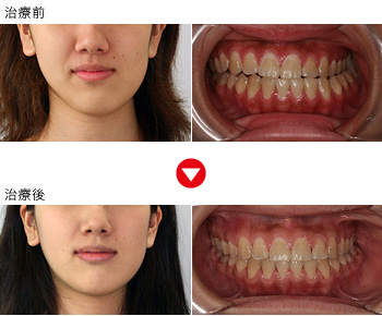 顎変形症を治すには外科手術が必要だと言われましたが、矯正歯科治療