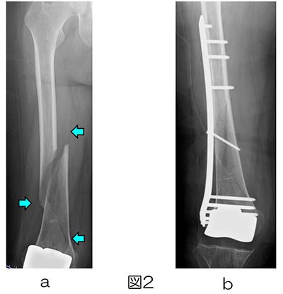 人工関節周囲骨折｜一般社団法人 日本整形外傷学会 骨折の解説