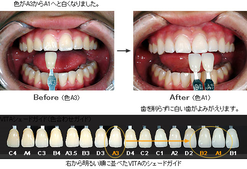 審美治療・ホワイトニング｜高松市 松崎ファミリー歯科矯正歯科
