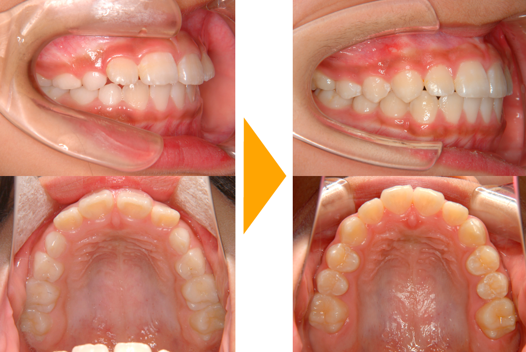 混合歯列期の矯正治療｜茨木市の歯医者（歯科医院）「みやの矯正・小児