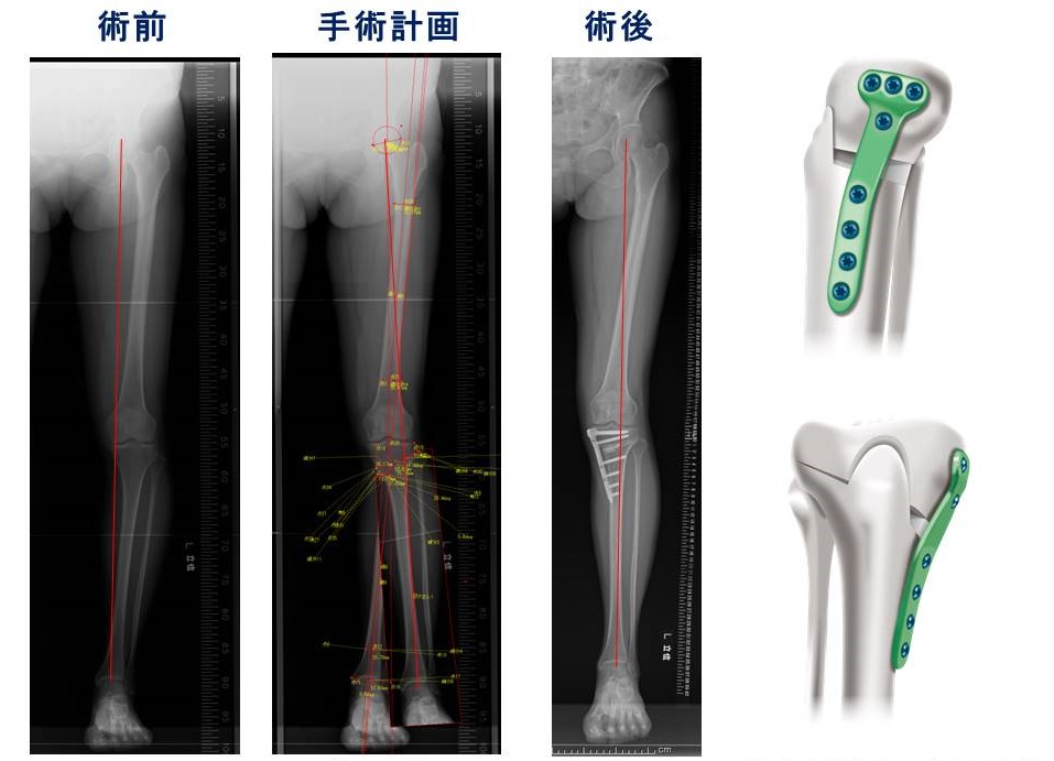 膝周囲骨切り術について | 診療科・部門 | 済生会横浜市南部病院