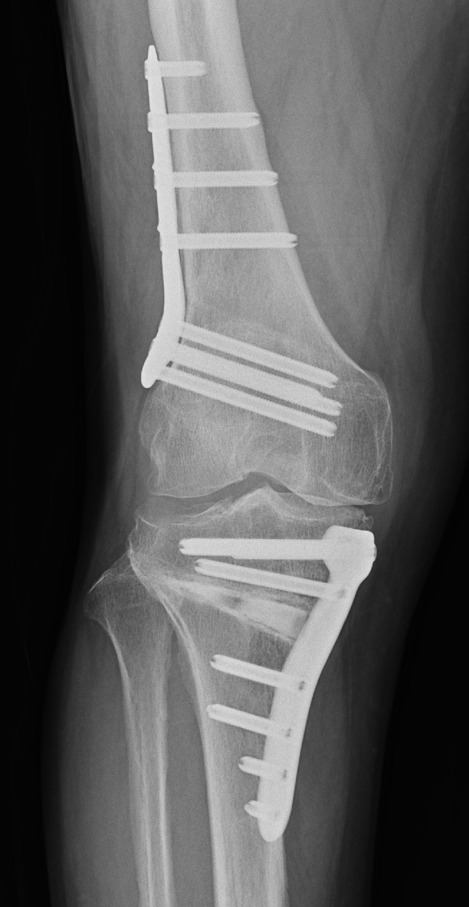 膝周囲骨切り術について | 診療科・部門 | 済生会横浜市南部病院