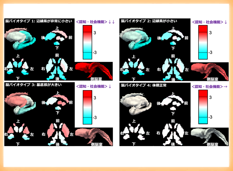 脳体積による精神疾患の新たな分類を提案 認知・社会機能と関連、精神