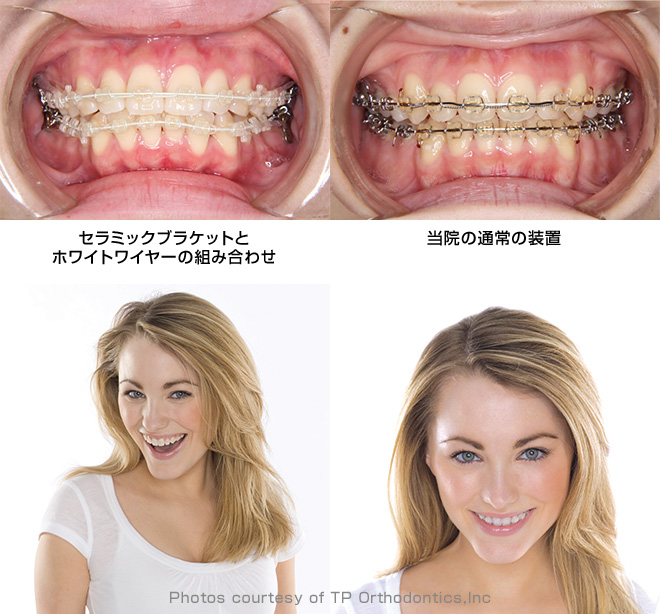 仙台の矯正歯科 西村矯正歯科クリニック.｜目立たない矯正治療