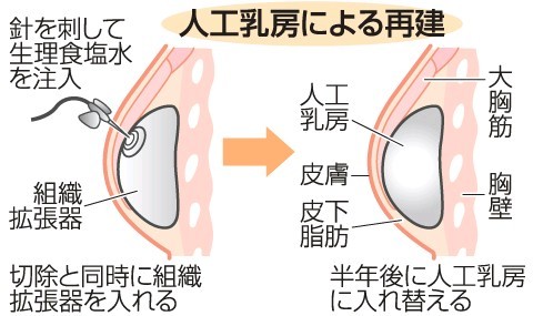 増える乳房同時再建 がん研有明病院 大野乳腺センター長に聞く 手術