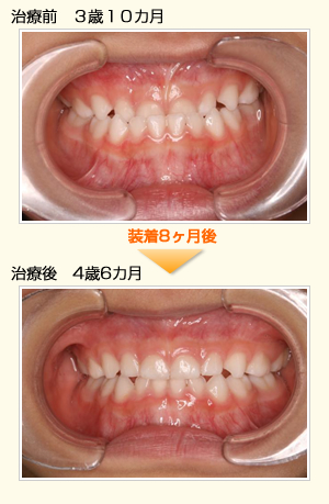 子供の矯正について | にしお歯科