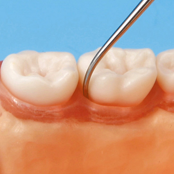 SRP実習用顎模型 [P15FE-DOT.2]｜株式会社ニッシン｜歯科模型・歯科