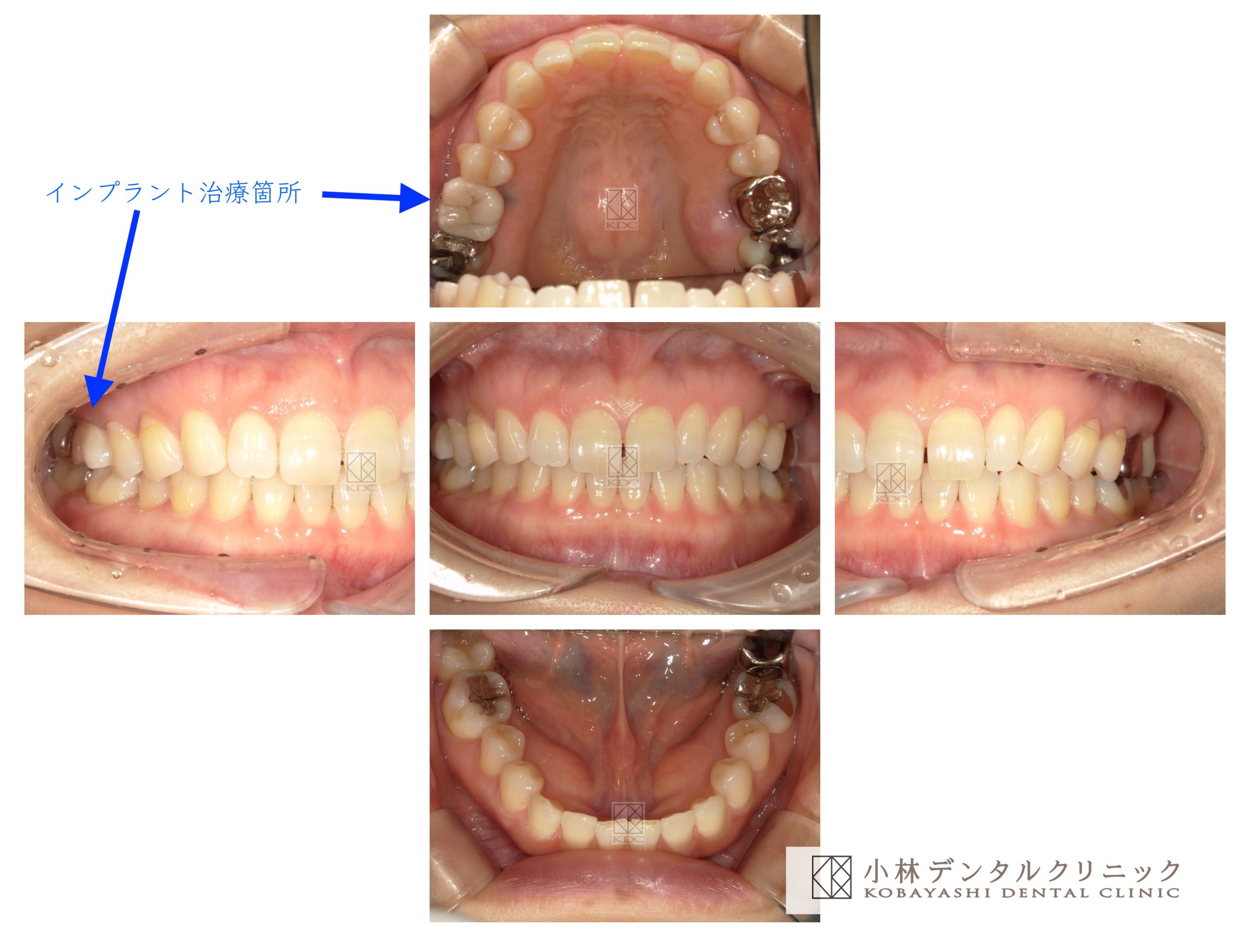 上顎大臼歯の低侵襲インプラント治療｜三田市の歯科・歯医者「小林