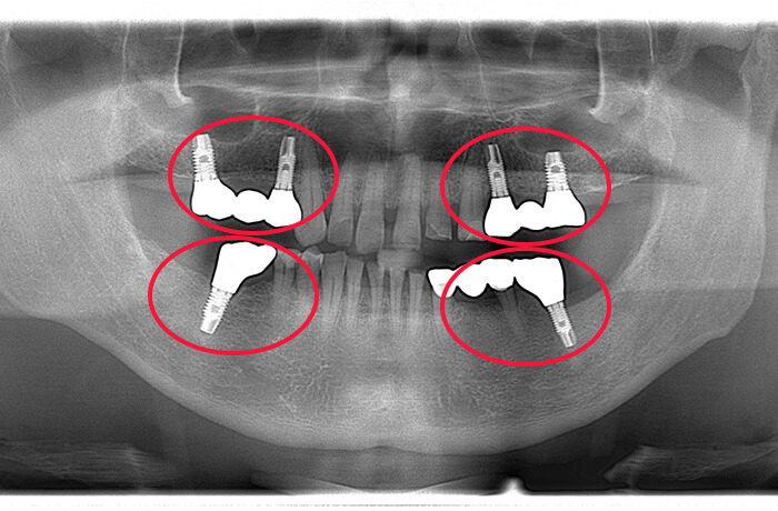 咬合再構成を含むインプラント｜横浜・町田でインプラント｜エス歯科