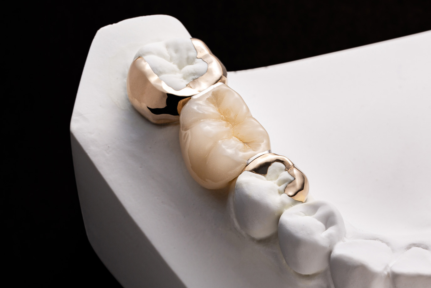 審美補綴物［MIブリッジ］｜株式会社シケン