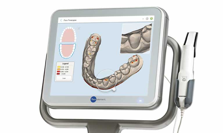 口腔内スキャナー iTero® element | 庄野歯科 北浜オフィス