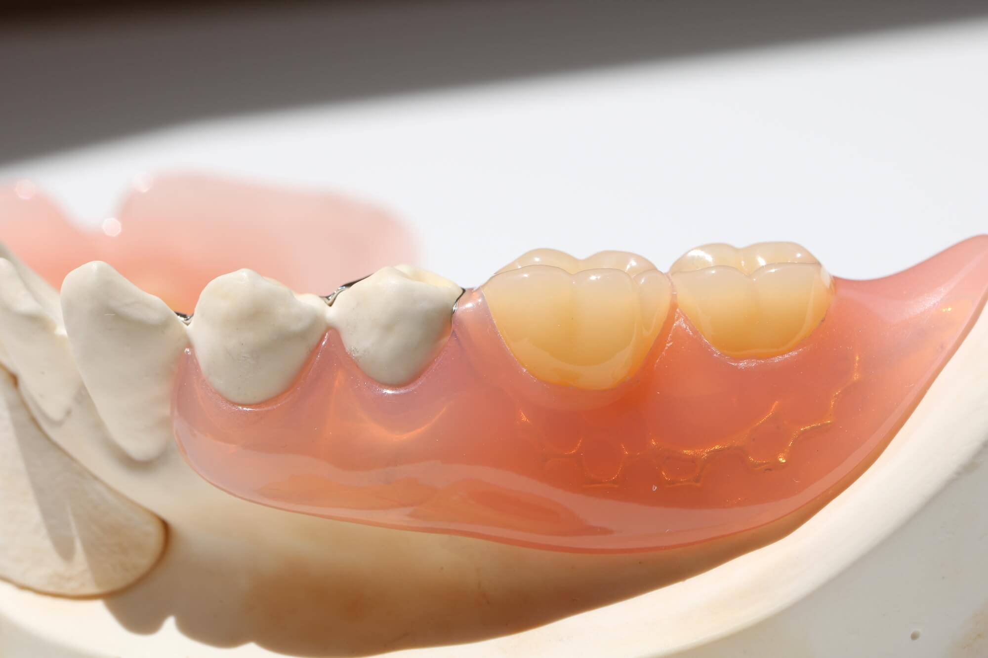 インプラントオーバーデンチャーとは？メリット・デメリットや治療費を