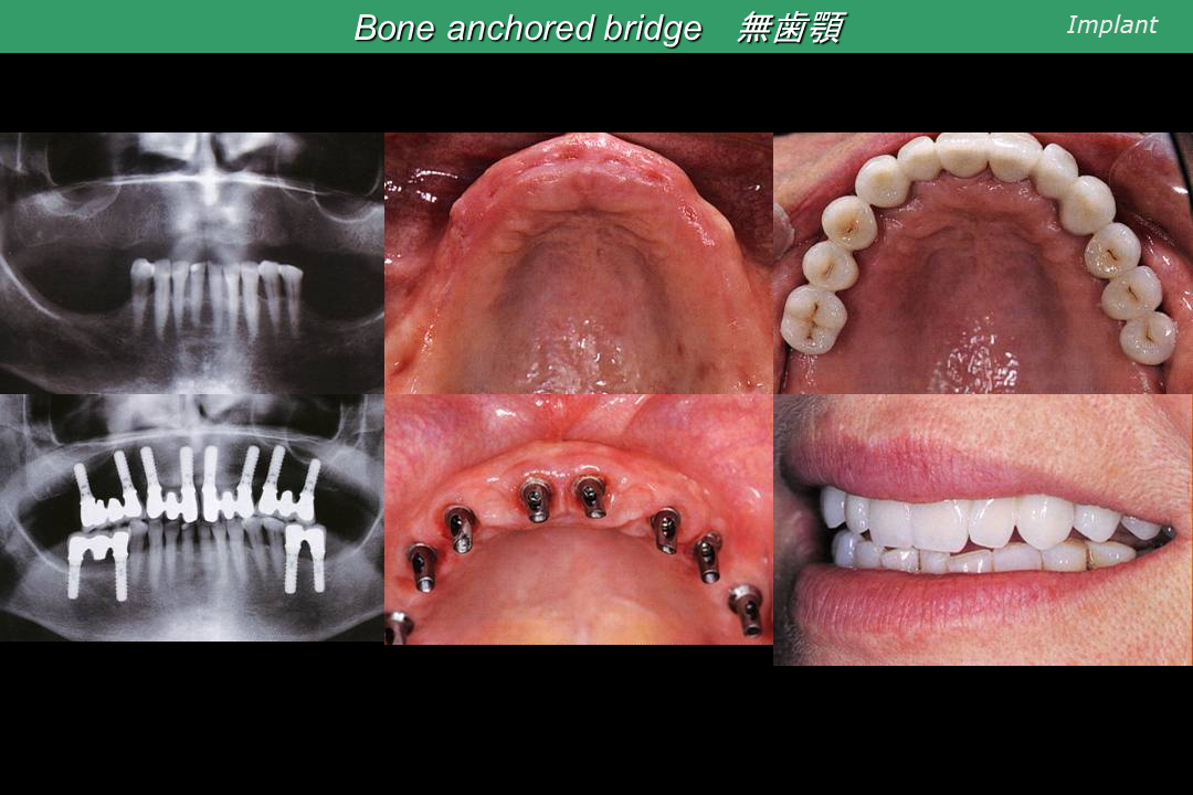 無歯顎のインプラント症例 | 青梅 歯医者/歯科｜高橋スマイル歯科