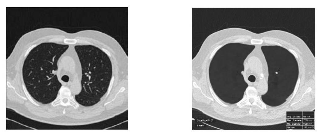 ディープラーニングで胸部CT読影を支援 | 日経クロステック（xTECH）