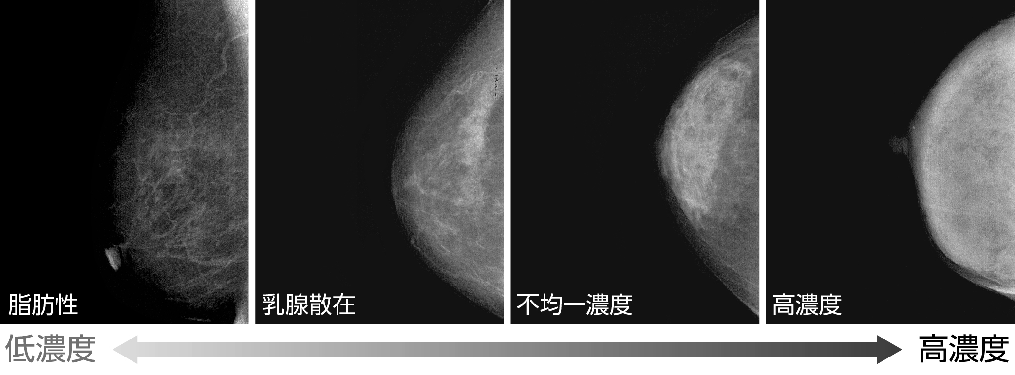 乳がん検診について | 吉田メディカルクリニック