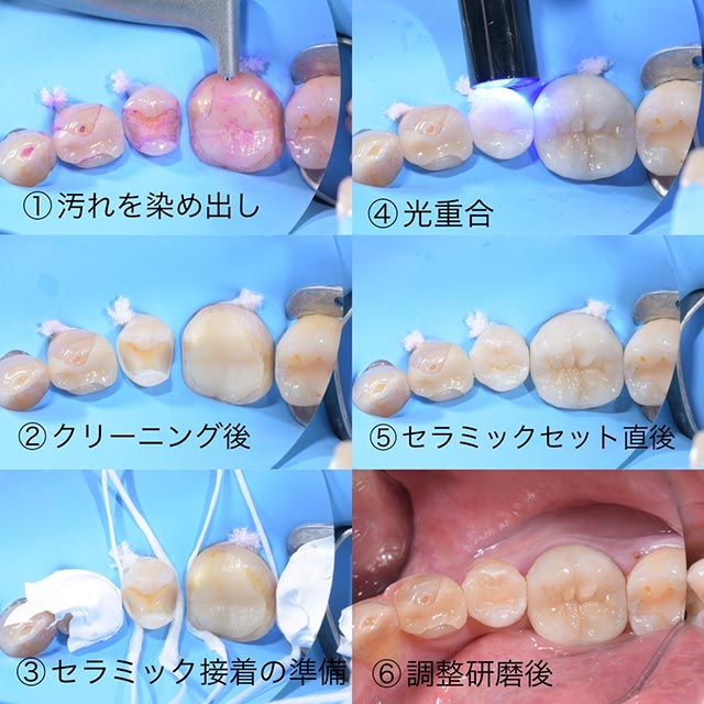 セラミック治療｜AOデンタルクリニック牛込神楽坂｜牛込神楽坂駅徒歩3分