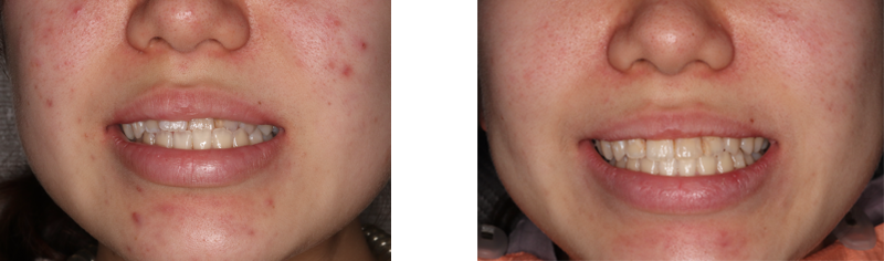 マウスピース矯正で受け口（反対咬合）はどこまで治せる？できる症例