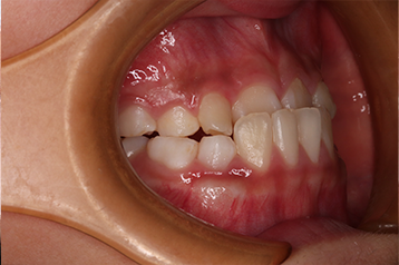 マウスピース矯正で受け口（反対咬合）はどこまで治せる？できる症例