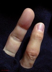 神奈川県藤沢市の義指(エピテーゼ)製作 ARTWORKS(アートワークス)