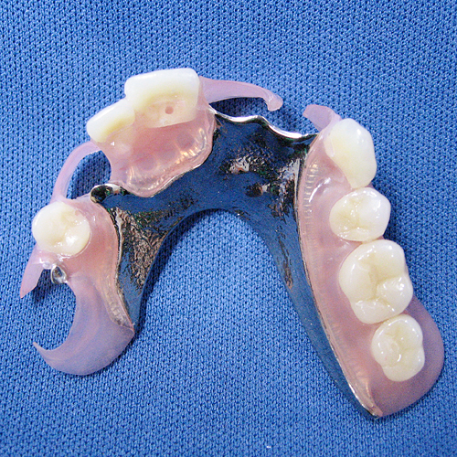 ノンクラスプデンチャー Non-Clasp Denture ::::: デンチャー専門ラボ