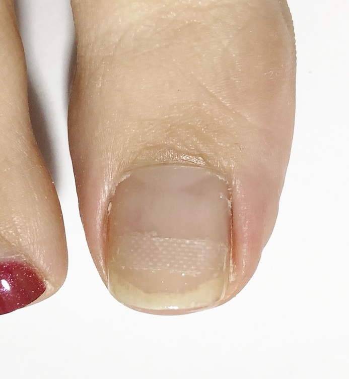 痛くない巻き爪補正：BSブレイス - 【公式】 エルロード自由が丘 美容室