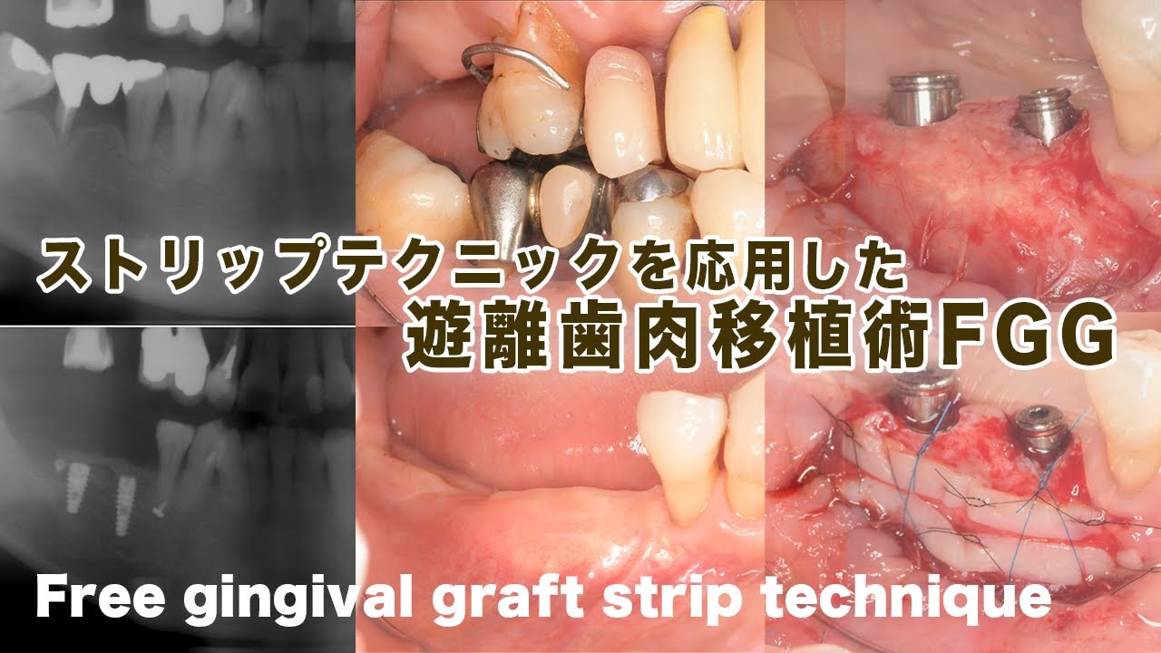ストリップテクニックを応用した【遊離歯肉移植術】Free gingival
