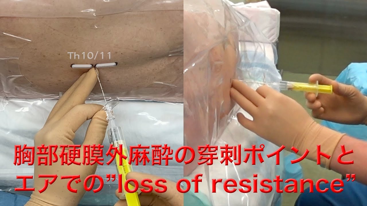 硬膜外麻酔穿刺ポイント Th10/11 エア