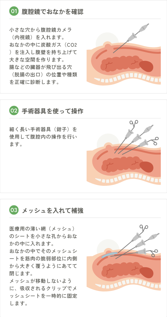 腹腔鏡下鼠径ヘルニア修復術（TAPP法） | 医療法人慶友会 守谷慶友病院